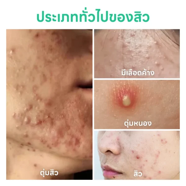 PAPA FEEL Salicylic Acid นักล่าสิว โลชั่นอบแห้ง 35ml-07