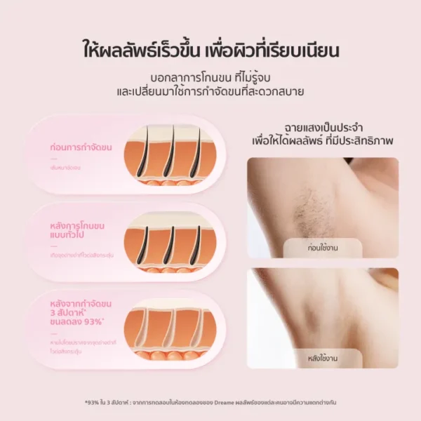 เลเซอร์กำจัดขน - 04